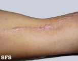 inflammatory linear verrucous epidermal naevi