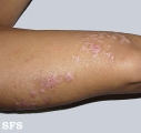 inflammatory linear verrucous epidermal naevi