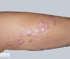 inflammatory linear verrucous epidermal naevi