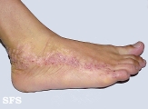 inflammatory linear verrucous epidermal naevi