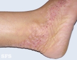 inflammatory linear verrucous epidermal naevi