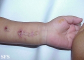 inflammatory linear verrucous epidermal naevi