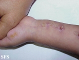 inflammatory linear verrucous epidermal naevi
