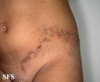 inflammatory linear verrucous epidermal naevi