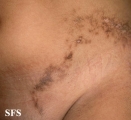 inflammatory linear verrucous epidermal naevi