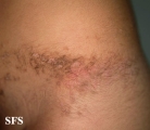 inflammatory linear verrucous epidermal naevi