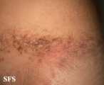 inflammatory linear verrucous epidermal naevi