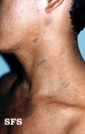 dermatosis cenicienta