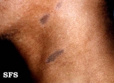 dermatosis cenicienta