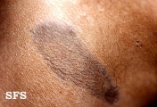 dermatosis cenicienta