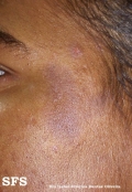 dermatosis cenicienta