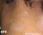 dermatosis cenicienta