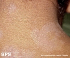 dermatosis cenicienta
