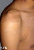 dermatosis cenicienta