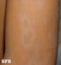 dermatosis cenicienta