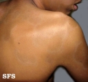 dermatosis cenicienta