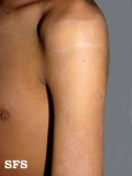 dermatosis cenicienta