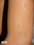 dermatosis cenicienta