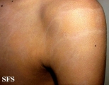 dermatosis cenicienta