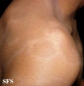 dermatosis cenicienta