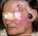 amelanotic lentigo maligna and melanoma