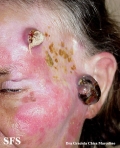 amelanotic lentigo maligna and melanoma