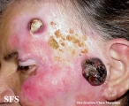 amelanotic lentigo maligna and melanoma