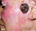 amelanotic lentigo maligna and melanoma