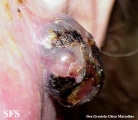 amelanotic lentigo maligna and melanoma