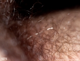 trichomycosis pubis