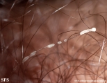 trichomycosis pubis
