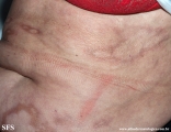 leprosy borderline