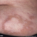 leprosy borderline