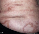 leprosy borderline