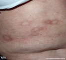 leprosy borderline
