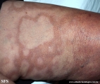 leprosy borderline