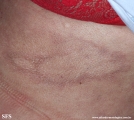 leprosy borderline