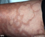 leprosy borderline