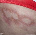 leprosy borderline