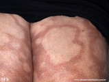leprosy borderline