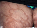 leprosy borderline