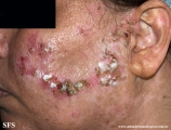 dermatosis neglecta