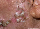 dermatosis neglecta