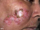 dermatosis neglecta