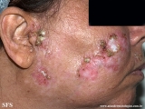 dermatosis neglecta