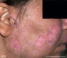 dermatosis neglecta