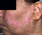 dermatosis neglecta