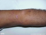 leprosy borderline