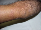 leprosy borderline
