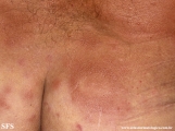 leprosy borderline